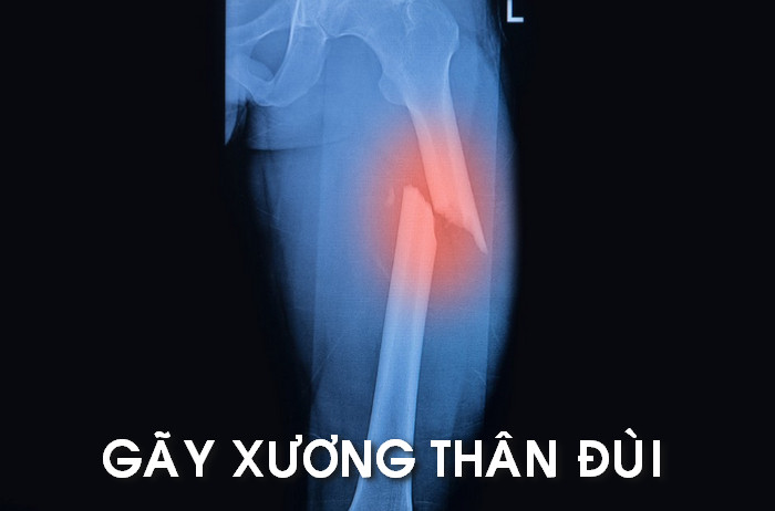 Gãy xương đùi - Hình ảnh minh họa